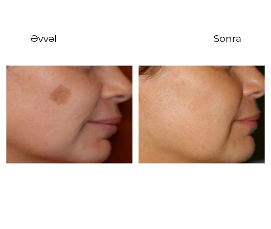 Candela GentleMax Pro